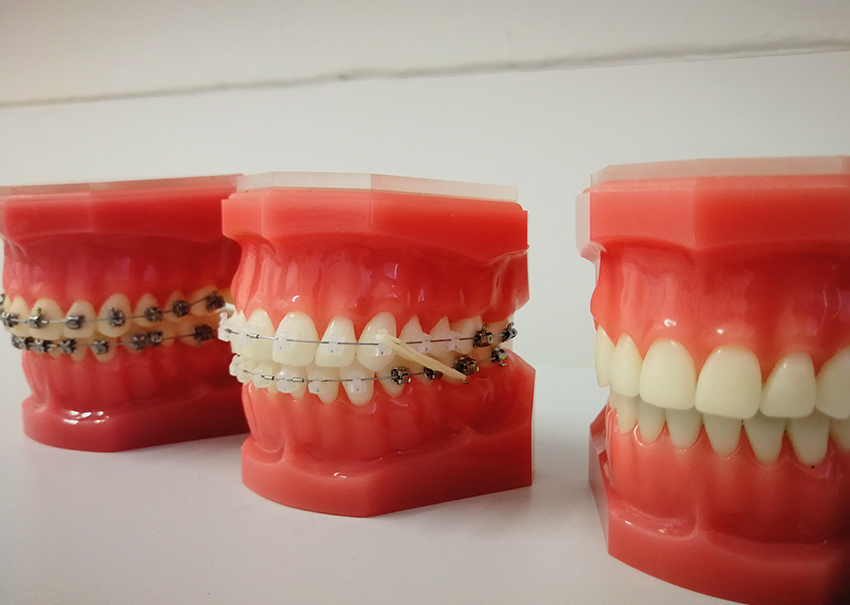 How Braces Move Teeth