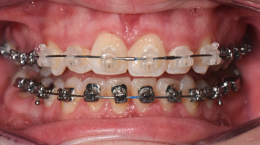 Rubber Bands Braces 101 - Orthodontics Limited